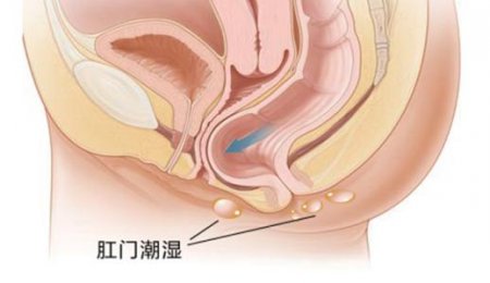 肛门潮湿怎么治疗好